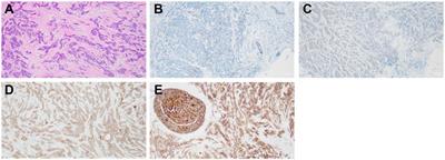 Correlation analysis of circulating tumor cells and Claudin-4 in breast cancer
